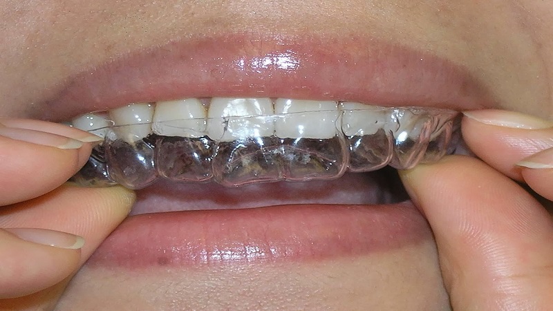  dental brace 
