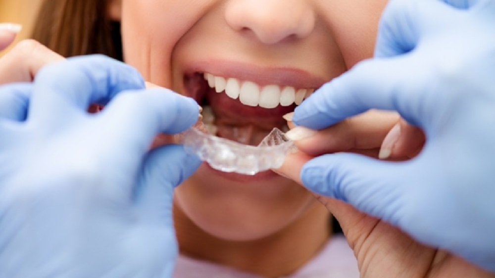 8 Do’s and Don’ts When Undergoing Invisalign Treatment